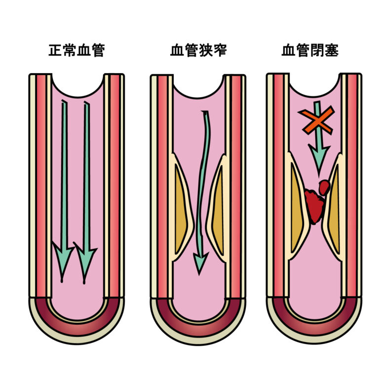 閉塞性動脈硬化症