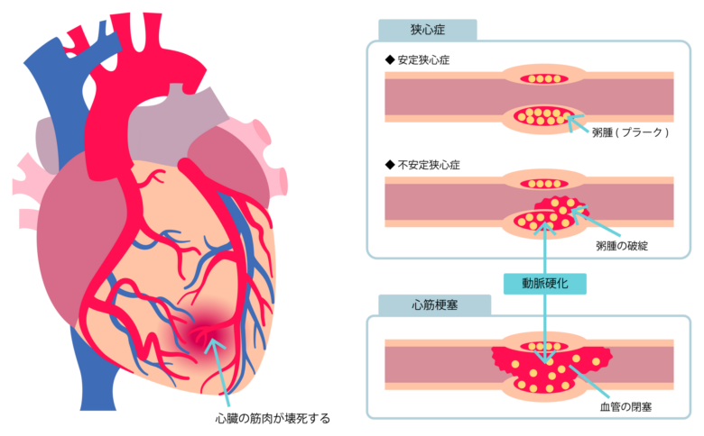 狭心症・心筋梗塞