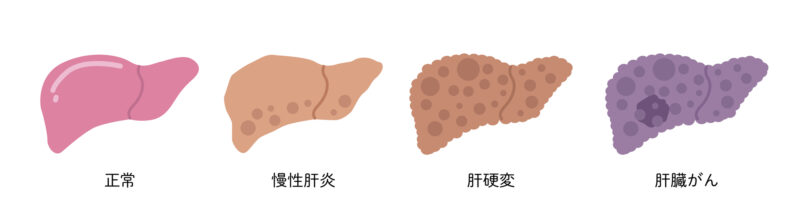 脂肪肝を放置することの危険性は